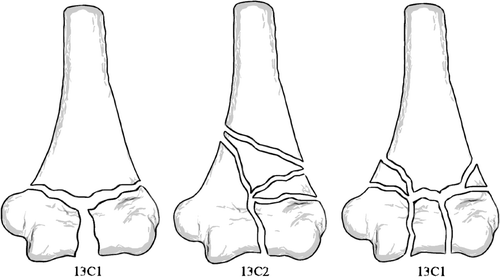Figure 2. OTA classification of complete articular fractures of the distal humerus (13C): (1) articular simple, metaphyseal simple; (2) articular simple, metaphyseal multifragmentary; and (3) multifragmentary.