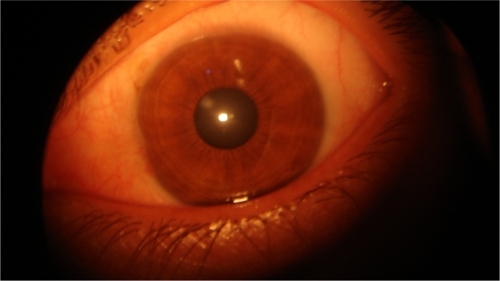 Figure 3B Left eye, appearance after four months treatment by 5-FU.