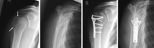 Figure 4. Patient no. 18 (Table 3) before and after open reduction and plate fixation of a moderately displaced fracture of the greater tuberosity (white arrows).