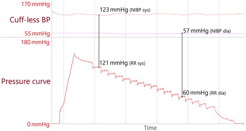 Figure 1. Original data; example of measurement pair generation. The upper panel displays the cuff-less, beat-to-beat BP with systolic BP in red and diastolic values in violet. The lower panel displays the inflation/deflation curve. The cuff-based measurement proved a measurement of 121/60 mmHg. Cuff-less BP values (123/57 mmHg) were retrieved at the exact time the pressure curve matched the cuff-based BP values, indicated by the black lines.