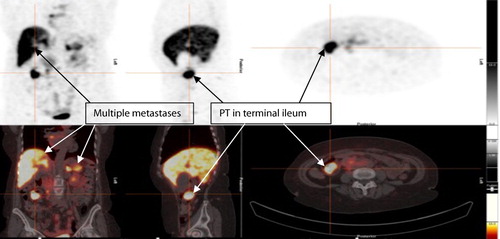 Figure 4: Ga 68 DOTANOC PET showing metastatic lesions and intense uptake of the primary lesion in the terminal ileum, with multiple metastases to liver, spleen and pancreas.