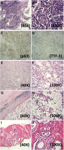 Figure 1 H&E staining of triple primary tumors and metastatic bone tumors of the case. (A and B) Primary lung SQCC (40x, 100x); (C and D) Immunohistochemistry staining of p63 and TTF1 for SQCC; (E and F) Primary CCRCC (40x, 100x); (G and H) Metastatic bone tumor (40x, 100x); (I and J) Primary prostate adenocarcinoma.