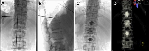 Figure 1 X-ray image scan and serial radiographs of PVP to T10–T12 in a patient with NSCLC with multifocal metastases.