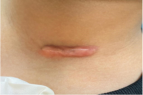 Figure 1 Keloid scar over the left anterior neck before treatment.