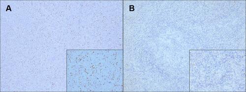 Figure 1 Representative immunohistochemistry images of GLUT-3 expression in diffuse large B-cell lymphoma tissues (×100, ×400). ((A) Diffuse large B-cell lymphoma tissues with high GLUT-3 expression); (B) Diffuse large B-cell lymphoma tissues with low GLUT-3 expression.