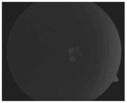 Figure 4 The preinjection photograph shows the characteristic autofluorescence of drusen.