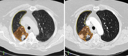 Figure 5. Pre- and post-treatment scans, showing radiological pneumonitis near the original tumor. Left: Deformed end-inspiratory phase of pre-treatment 4D-CT scan, with a right-sided tumor evident. The ipsilateral lung (yellow) and 3-cm expansion around the tumor (orange) are contoured. Right: Follow-up scan three months later, showing good resolution of the tumor, with a new area of radiological pneumonitis in the peri-tumoral region.