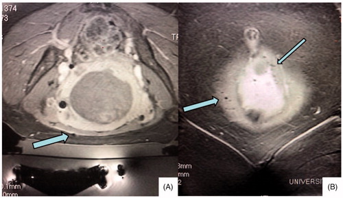 Figure 3. Sagittal (A) and coronal (B) post contrast post MRgFUS treatment images show moderate artifacts (arrows). Although the patient has several artifacts, they are small and most are visible only in the coronal plane.