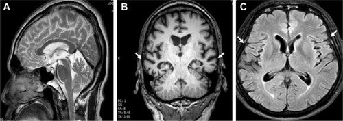 Figure 2 Structural MRI sequences. (A) T1-weighted MRI image of the patient with Alzheimer’s disease with sagittal view. (B) Coronal T2WI. (C) Axial T2WI.