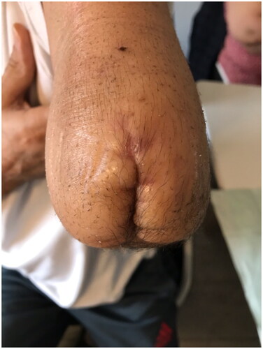 Figure 6. Appearance of the amputation stump at 6-month follow-up.