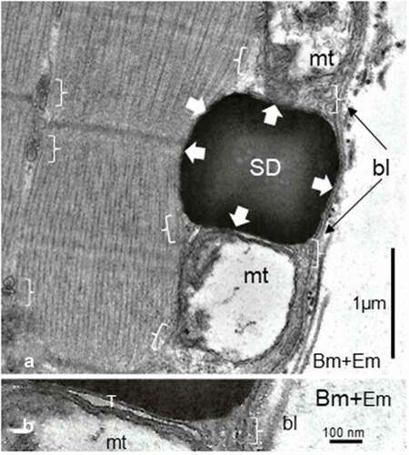 Figure 5. a-b Female Zucker FG tibialis muscle. a: SD deposit enlarged in the subsarcolemmal zone to view its inherent deformations (white arrows) caused by its adjacent muscle fiber substructures: sarcolemma, adjacents T-tubule (T), damaged mitochondria and myofibril. This later one also displayed a ‘compressed’ aspect, centered at and around its Z disc intersarcomere zone. Brackets: triad structures, including those displaced by deposit; bl: basal lamina; mt: mitochondrion. B: Enlarged aspect to verify the absence of membrane lining of the SD but T-tubule and part of mitochondria envelope are there, recognized. bl: basal lamina; Bm: Basement membrane; Em: endomysium