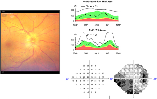 Figure 7 Case 1 - OCT ONH exhibiting diffuse optic disc edema, with a swollen optic nerve head diffusely, displaying increased thickness markers in the superior and inferior quadrants. This condition led to a significant scotoma in the Humphrey visual field analysis (HFA) of the right eye.