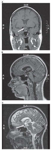 Figure 6 Postoperative MRI. A) MRI, coronal section, T1-weighted images: a postoperative defect inside the chiasm is visible. B) MRI, sagittal section, T1-weighted images after administration of gadolinium: no residual cavernoma is visible. C) MRI, sagittal section, T2-weighted images revealing complete resection of the cavernoma with minimal hemosiderin residuals.