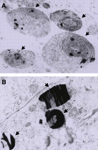 Figure 6 Effects of the oral administration of Hg on the ultrastucture of epididymis. (A) Myelinic figures (arrows) and (B) Crystal deposits in lysosomes of principal cells (arrows) from rats treated with 0.05 μg/ml of Hg for 3 months (6600X each).