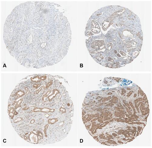 Figure 1 PMI expression in various levels in PDAC surgical tissue microarray. (A) Intensity 0; (B) Intensity 1; (C) Intensity 2; (D) Intensity 3.