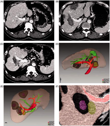Figure 2. Images of a 54-year-old male patient with HCC who was treated with RFA. Among the three treated lesions, LTP occurred in one tumour at 9 months after treatment. (A) Conventional axial CT image in the portal phase shows HCC before ablation; (B) conventional axial CT image in the portal phase 1 month after ablation shows complete ablation; (C) conventional axial CT image in the portal phase when LTP (black arrow) is detected; (D, E) combined 3D images of the initial tumour (obtained before ablation), the ablation zone (obtained 1 month after ablation) and LTP (obtained 9 months after ablation) in various directions show their spatial relationship; (F) local enlargement images show the position relationship of the initial tumour, the ablation zone and LTP. On this image, the LTP-associated AM is 6.7 mm.