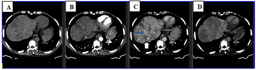 Figure 1 Axial section of triphasic abdominal CT scan at the level of upper liver shows heterogeneous liver parenchyma on precontrast image (A) that shows caudate lobe and central parenchymal enhancement on arterial and portal phases (B and C). The periphery of the liver enhances with central low density on delayed image (D). The middle and left hepatic veins are not visualized, while right hepatic vein and intrahepatic IVC have luminal narrowing (blue and white arrows on C respectively).