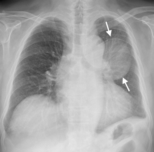 Figure 3 The follow-up chest radiograph obtained after intensive therapy and 8 weeks of co-trimoxazole monotherapy showing a slight decrease in size of the left upper lobe mass (arrows), which suggests partial regression of melioidosis within lung cancer.