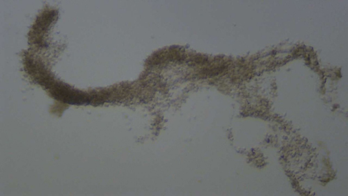 Figure 8 Branched glandular-shaped aged white cell clumps (magnified 200x under microscopy).