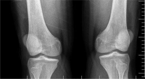 Figure 1 Anteroposterior plain radiography of both knees.