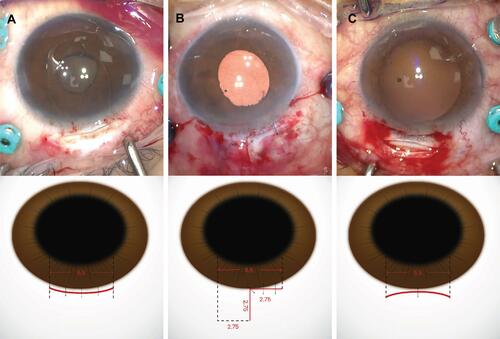 Figure 1 Representative photographs during the surgery and a schematic illustration of each incision type used; (A) a conventional 5.5-mm sclerocorneal incision, (B) L-shaped incision, and (C) frown incision.