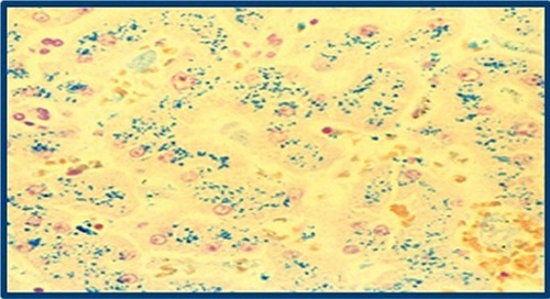 Figure 2 Prussian blue stain of patient’s liver biopsy to rule out any presence of autoimmune disease or viral etiology.