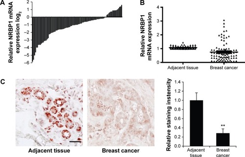 Figure 1 NRBP1 is downregulated in breast cancer.