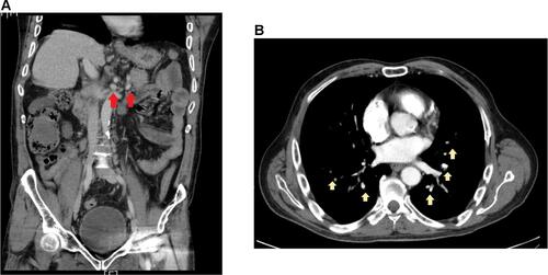 Figure 1 Computed tomography scan of abdominopelvic, coronal view showing enlargement of multiple Para-aortic lymph nodes (A). Computed tomography scan of chest, axial view showing enlargement of multiple lymph nodes in aortopulmonary window (B). Arrows show enlargement of multiple Para-aortic lymph nodes.