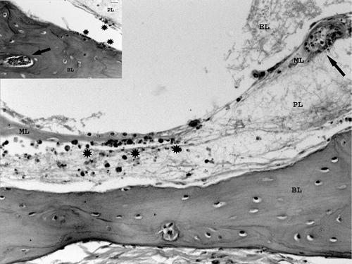 Figure 4.  Magnified view of Figure 1. Semicircular canal with heterophilic inflammation of the perilymph (asterisks). Vasculitis in vessels of the membranous and bony labyrinths (arrows). Inset: vasculitis in bony labyrinth and heterophils in perilymph and endosteal surface (Bar = 10 µm). BL, Bony labyrinth; PL, perilymph; ML, membranous labyrinth; EL, endolymph. Haematoxylin and eosin. Bar = 20 µm.
