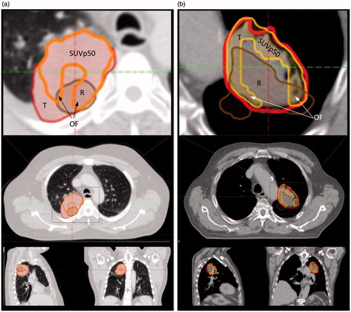Figure 3. Two cases showing overlap between recurrence (rec) tumor (R, brown), SUVp50 (orange) and GTV-tumor (T, red) on planning-CT (p-CT). The p-CT and rec-CT were rigidly registered. The structures are shown on p-CT. (a) p-CT is represented in lung window showing T, SUVp50, R and the overlap fraction (OF) area. (b) p-CT representing a case with a donut shaped SUVp50 area resulting in low OFSUVp50 as tumor (GTV-T) was characterized necrotic in central part. Gross tumor volumes = red lines; recurrence tumor = brown lines, rigid registered on p-CT (left columns).