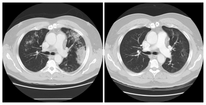 Figure 2 Response of ALK-rearranged NSCLC after 2 months of crizotinib.