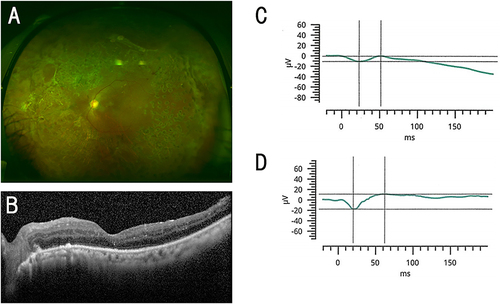 Figure 1 Findings in a 53-year-old woman who had ERG responses in her silicone (SO) filled eye. (A) Fundus photograph of the left eye after the SO removal. (B) Optical coherence tomographic (OCT) image of the left eye after the SO removal. (C) Combined rod-cone response before SO removal. (D) Combined rod-cone response after SO removal. The decimal visual acuity improved from 0.3 to 0.6 (from 0.52 to 0.22 logarithm of the minimum angle of resolution; logMAR units) after the SO removal.