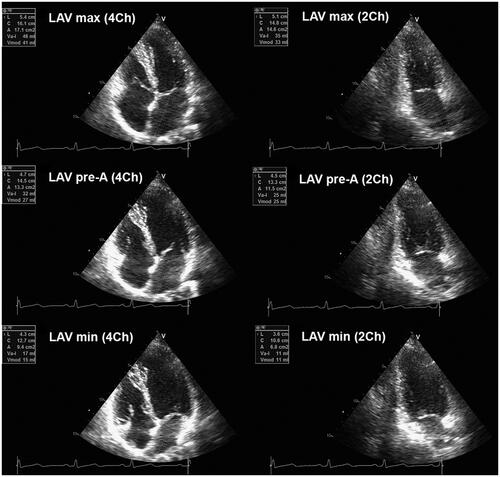 Figure 1. Maximum, minimum, and pre-A left atrial volume (LAV) assessed by two-dimensional echocardiography.