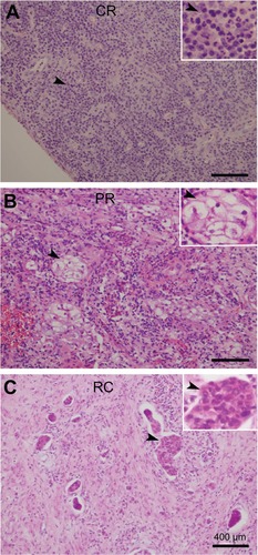 Figure 2 (A–C) Three major pathological responses, ie, complete response (CR), partial response (PR), and residual carcinoma (RC) in patients treated with preoperative concurrent chemoradiotherapy or radiotherapy alone. CR (A) shows mainly inflammatory cell infiltration, PR (B) shows presence of persistent atypical cells or cervical intraepithelial neoplasia, and RC (C) shows residual tumor tissue or tumor cells in cervical tissue.