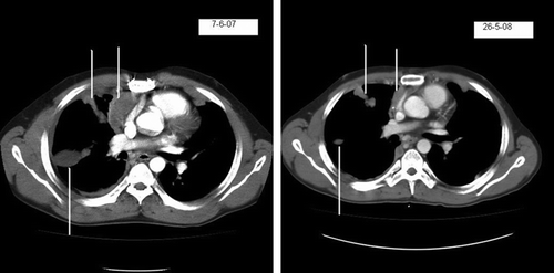 Figure 1.  CT scans done at baseline (7/6/07) and after 17 cycles (26-5-08) of treatment with motesanib diphosphate showing reduction in pleurally-based masses.