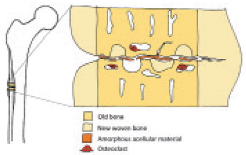 Figure 3. Schematic view of histology, showing necrotic material in the gap, resorption near the gap, and areas of new woven bone. Periosteal callus to the left.