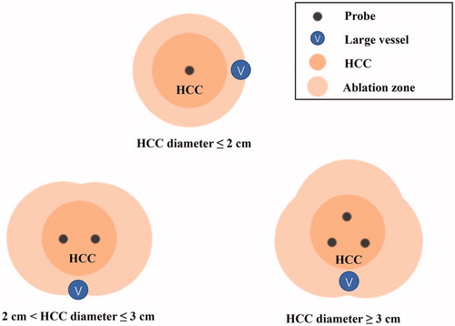 Figure 3. Schematic diagram of ablation modes for nodules with different diameters. HCC: hepatocellular carcinoma.
