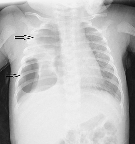 Figure 1 (Chest X-Ray) White arrows in right lung shows cystic lesions.