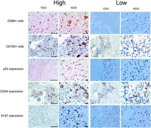 Figure 2 Representative images of tumor-associated macrophages parameters and immunohistochemical markers in chondroblastoma tissues.