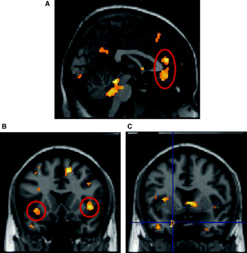 Figure 4.  Interaction between feedback condition and variance in pupil size showing significant activation in: (A) anterior cingulated; (B) left amygdala; (C) bilateral anterior insula for negative > positive feedback. Activations plotted at p=.05 for illustration, only clusters of 50 or more voxels shown.