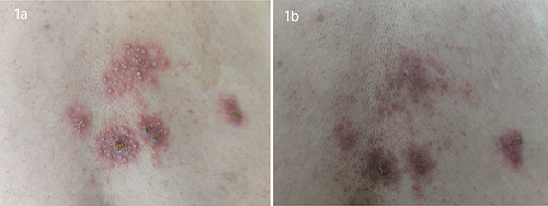 Figure 1 (a) Lesions on admission, showing clusters of papules and pustules on; (b) lesions at 15 days after discharge, no obvious papules or pustules, post inflammatory hyperpigmentation can be seen.