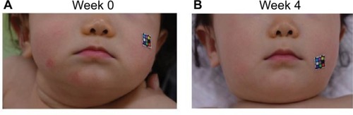 Figure 2 Typical clinical features of facial skin in an 8-month-old female infant.