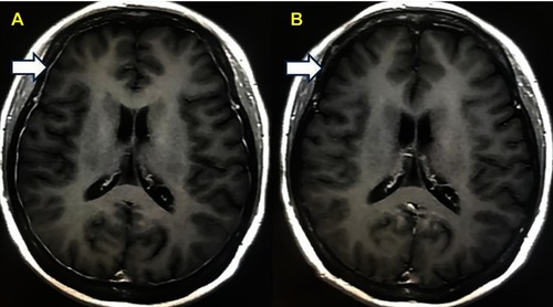 Figure 1 (A) The MRI of the patient when neurological symptoms appeared. (B) The MRI of the patient after treatment.Abbreviation: MRI, magnetic resonance imaging.