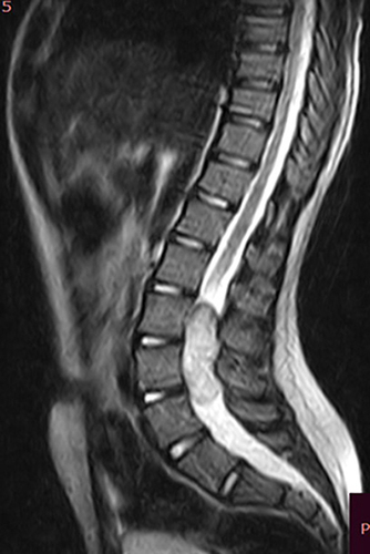 Figure 1 Lumbosacral MRI of the patient preoperatively done sagittal T2 image demonstrating hyperintense lesion extending from L2-L4.
