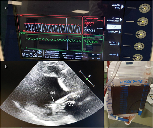 Figure 5. Signs of abnormal position. Example of a patient with pVAD close to the mitral valve apparatus, causing hemolysis without suction alarm. A. Subtle shift of the ventricular waveform (white) below the placement signal (red) suggests suboptimal position. B. Echocardiography shows abnormal angle of pVAD with inlet close to the mitral valve. C. Urine bag showing hemoglobinuria. AoV = aortic valve. LA = left atrium. LV = left ventricle. MV = mitral valve.