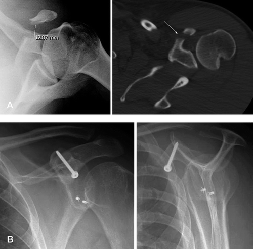 Figure 4 A. AP radiograph (left) and CT scan of the scapula (right) showing fracture of the middle coracoid with > 1 cm of displacement. B. AP (left) and lateral (right) radiographs after open reduction and internal fixation using a cortical lag screw.