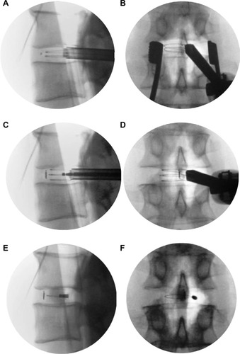Figure 3 Lateral (A) and anteroposterior (B) radiographic views of initial deployment, middle component deployment (C and D), and fully deployed Luna 3D® (Benvenue Medical Inc., Santa Clara, CA, USA) lumbar interbody fusion cage (E and F).