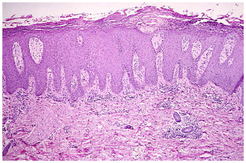 Figure 3 Histopathology of a psoriatic plaque.