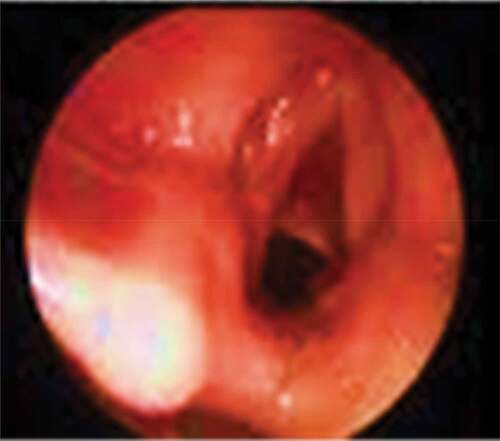 Figure 1. Grade II subglottic stenosis in the proximal trachea