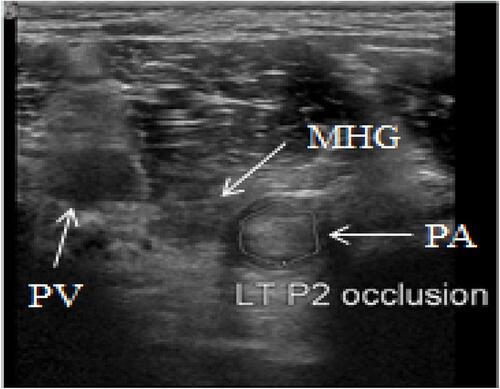 Figure 1 Doppler ultrasonography of left knee posterior side, the dotted circle is P2 segment occlusion with thrombosis formation at the popliteal artery.Abbreviations: PA, popliteal artery; PV, popliteal vein; MHG, medial head of gastrocnemius muscle.